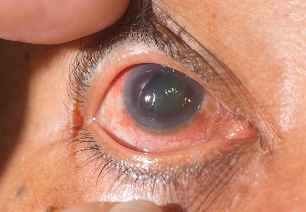 glaucoma